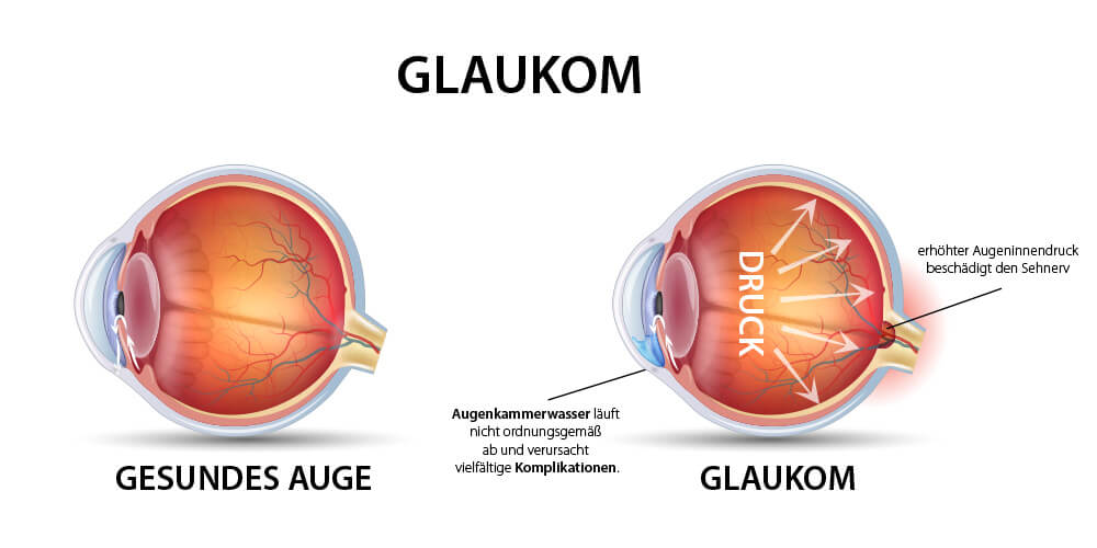 glaukom_ansicht
